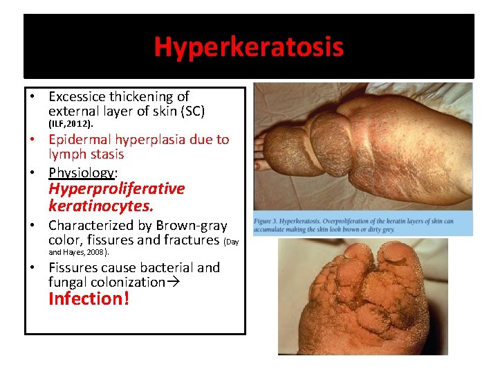 Hyperkeratosis • Excessice thickening of external layer of skin (SC) (ILF, 2012). • Epidermal