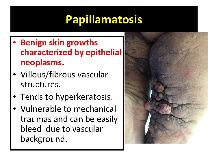 Papillamatosis • Benign skin growths characterized by epithelial neoplasms. • Villous/fibrous vascular structures. •