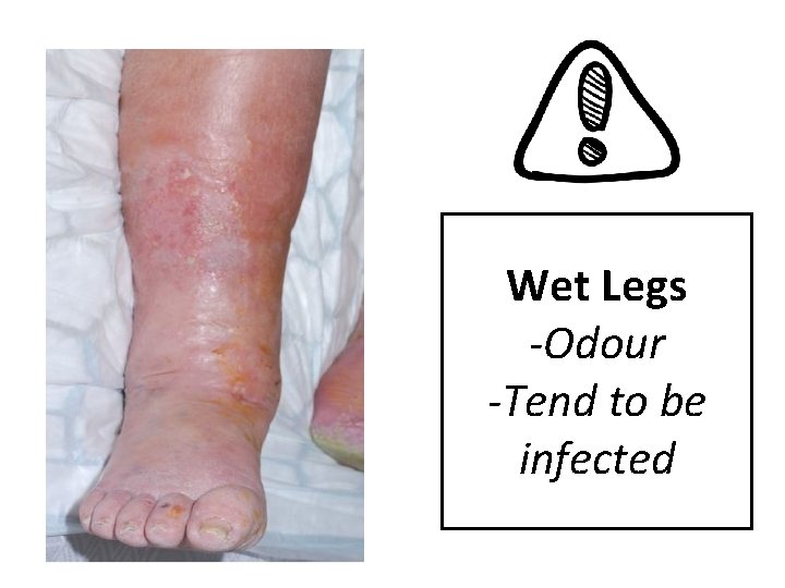 Wet Legs -Odour -Tend to be infected 