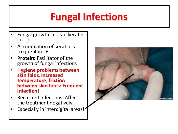 Fungal Infections • Fungal growth in dead keratin (+++) • Accumulation of keratin is