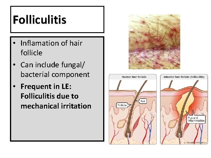 Folliculitis • Inflamation of hair follicle • Can include fungal/ bacterial component • Frequent