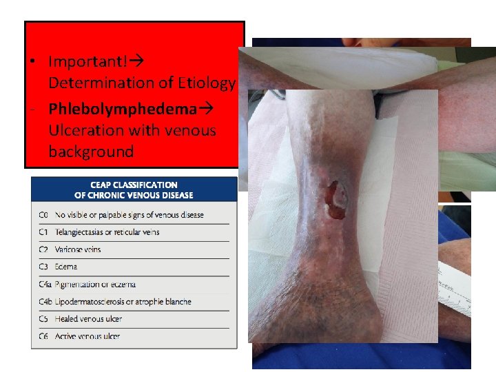  • Important! Determination of Etiology ‐ Phlebolymphedema Ulceration with venous background 