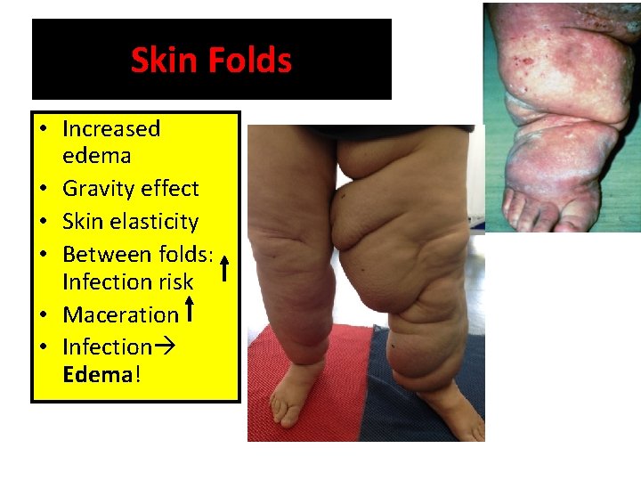 Skin Folds • Increased edema • Gravity effect • Skin elasticity • Between folds: