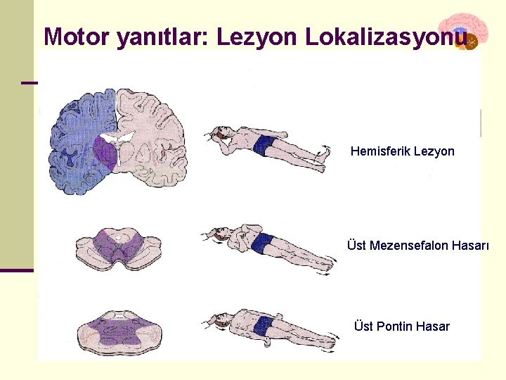 Motor yanıtlar: Lezyon Lokalizasyonu Hemisferik Lezyon Üst Mezensefalon Hasarı Üst Pontin Hasar İstanbul, Kasım