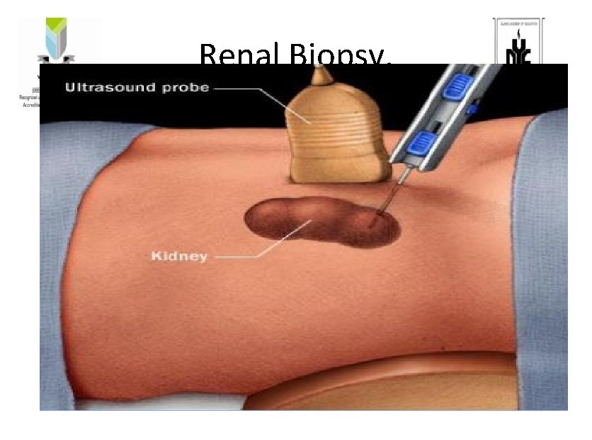 Renal Biopsy. Renal Biopsy.