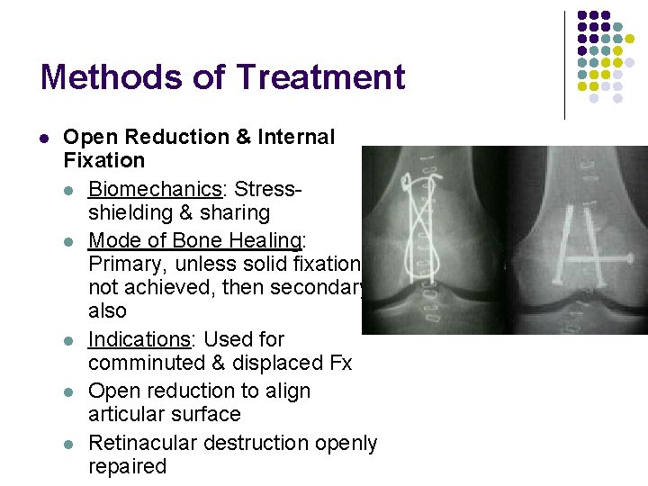 Methods of Treatment l Open Reduction & Internal Fixation l Biomechanics: Stressshielding & sharing