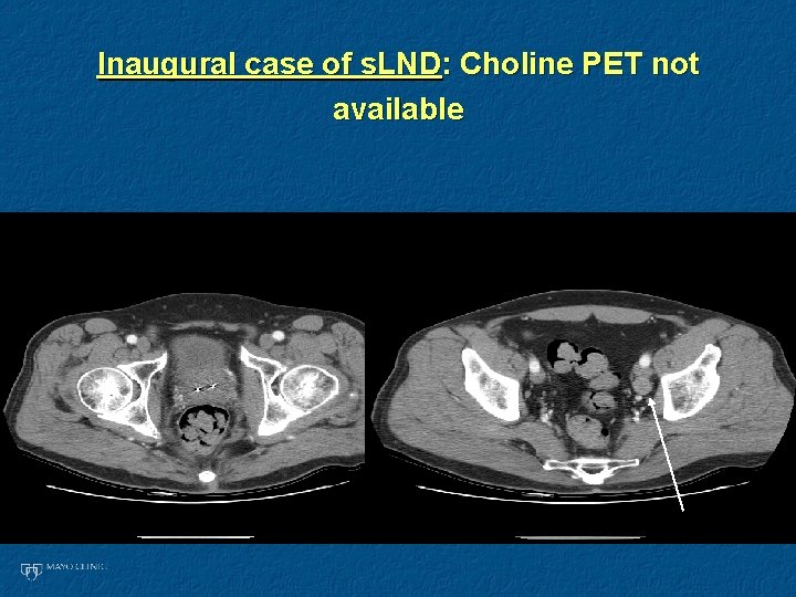 Inaugural case of s. LND: Choline PET not available Inaugural case of s. LND: Choline PET not available