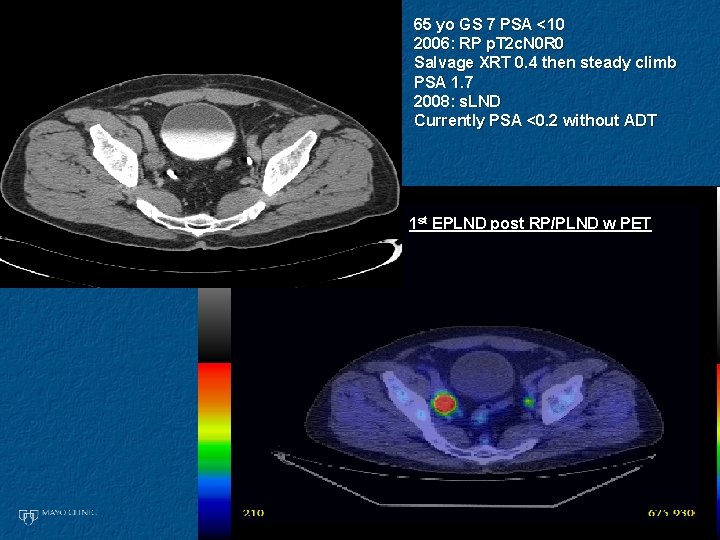 65 yo GS 7 PSA <10 2006: RP p. T 2 c. N 0 65 yo GS 7 PSA <10 2006: RP p. T 2 c. N 0