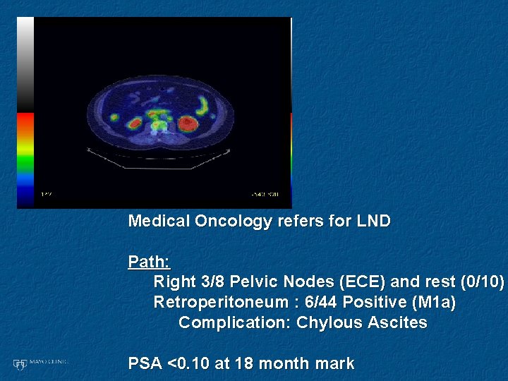 Medical Oncology refers for LND Path: Right 3/8 Pelvic Nodes (ECE) and rest (0/10) Medical Oncology refers for LND Path: Right 3/8 Pelvic Nodes (ECE) and rest (0/10)