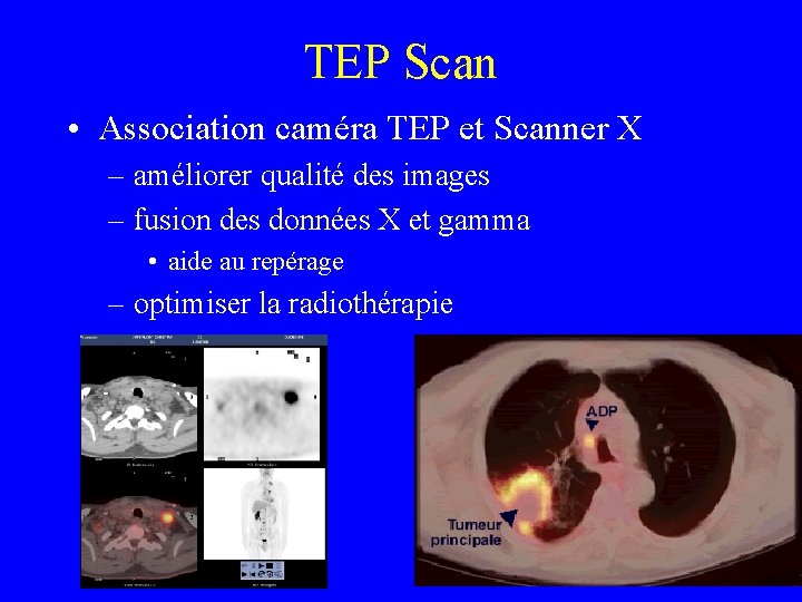 TEP Scan • Association caméra TEP et Scanner X – améliorer qualité des images