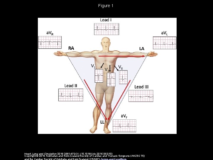 Figure 1 Heart, Lung and Circulation 2016 2561 -67 DOI: (10. 1016/j. hlc. 2015.