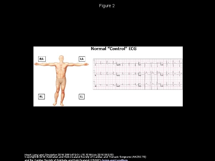 Figure 2 Heart, Lung and Circulation 2016 2561 -67 DOI: (10. 1016/j. hlc. 2015.
