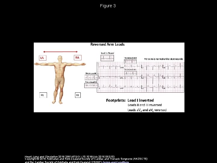 Figure 3 Heart, Lung and Circulation 2016 2561 -67 DOI: (10. 1016/j. hlc. 2015.