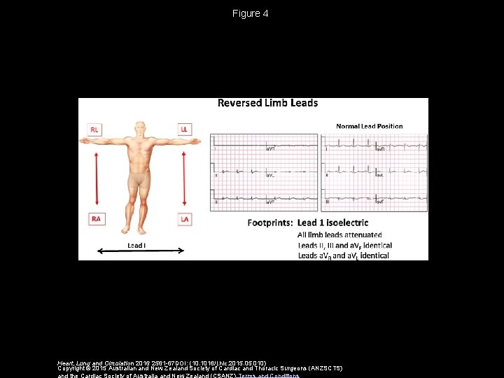 Figure 4 Heart, Lung and Circulation 2016 2561 -67 DOI: (10. 1016/j. hlc. 2015.