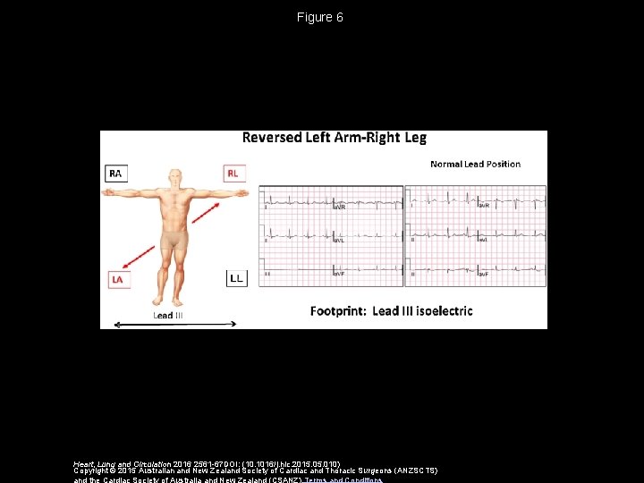 Figure 6 Heart, Lung and Circulation 2016 2561 -67 DOI: (10. 1016/j. hlc. 2015.