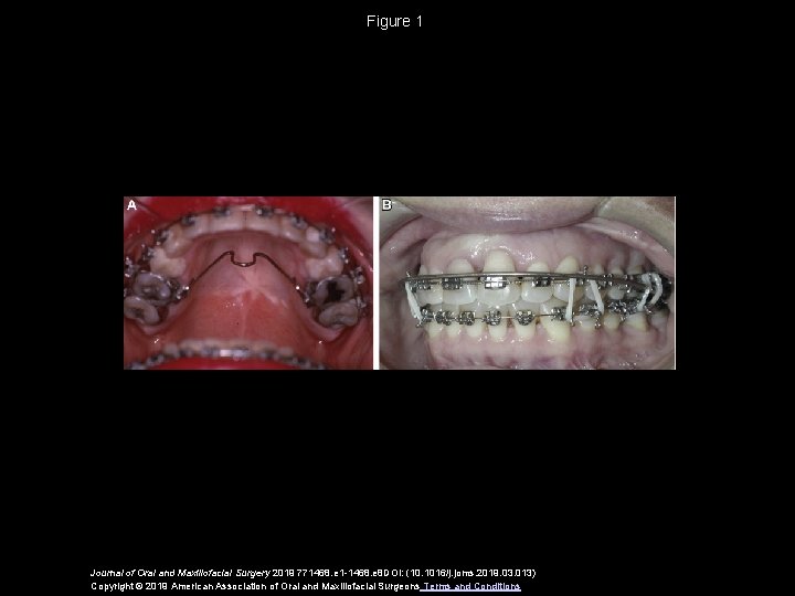 Figure 1 Journal of Oral and Maxillofacial Surgery 2019 771468. e 1 -1468. e