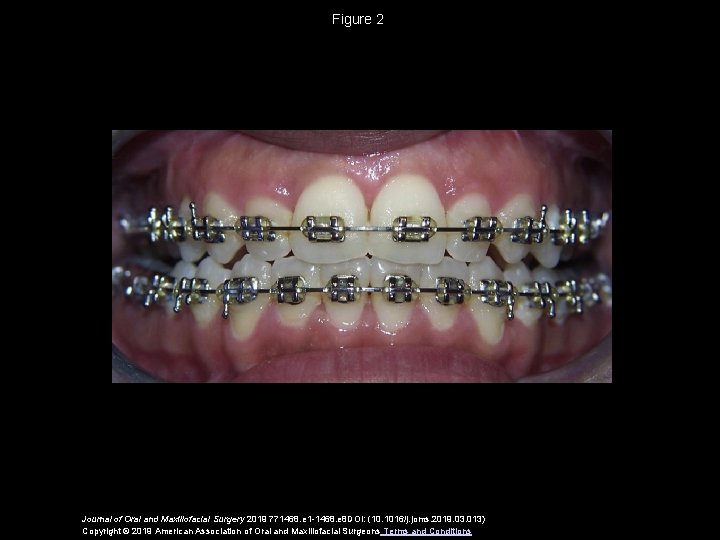 Figure 2 Journal of Oral and Maxillofacial Surgery 2019 771468. e 1 -1468. e