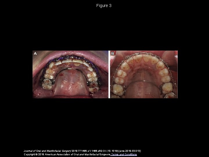 Figure 3 Journal of Oral and Maxillofacial Surgery 2019 771468. e 1 -1468. e