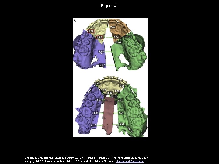 Figure 4 Journal of Oral and Maxillofacial Surgery 2019 771468. e 1 -1468. e