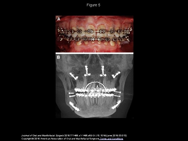 Figure 5 Journal of Oral and Maxillofacial Surgery 2019 771468. e 1 -1468. e