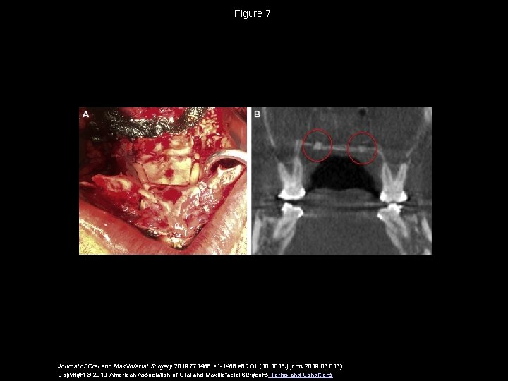 Figure 7 Journal of Oral and Maxillofacial Surgery 2019 771468. e 1 -1468. e