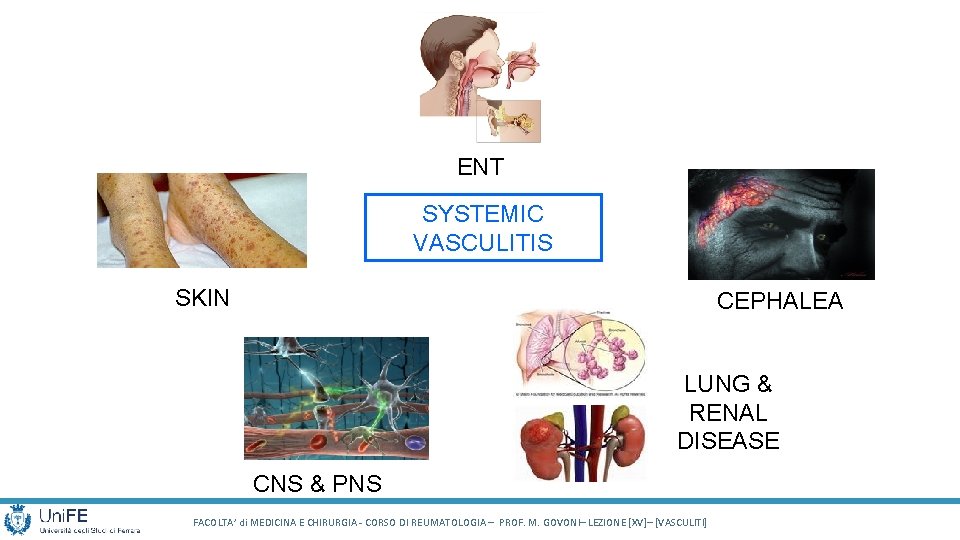 ENT SYSTEMIC VASCULITIS SKIN CEPHALEA LUNG & RENAL DISEASE CNS & PNS FACOLTA’ di ENT SYSTEMIC VASCULITIS SKIN CEPHALEA LUNG & RENAL DISEASE CNS & PNS FACOLTA’ di