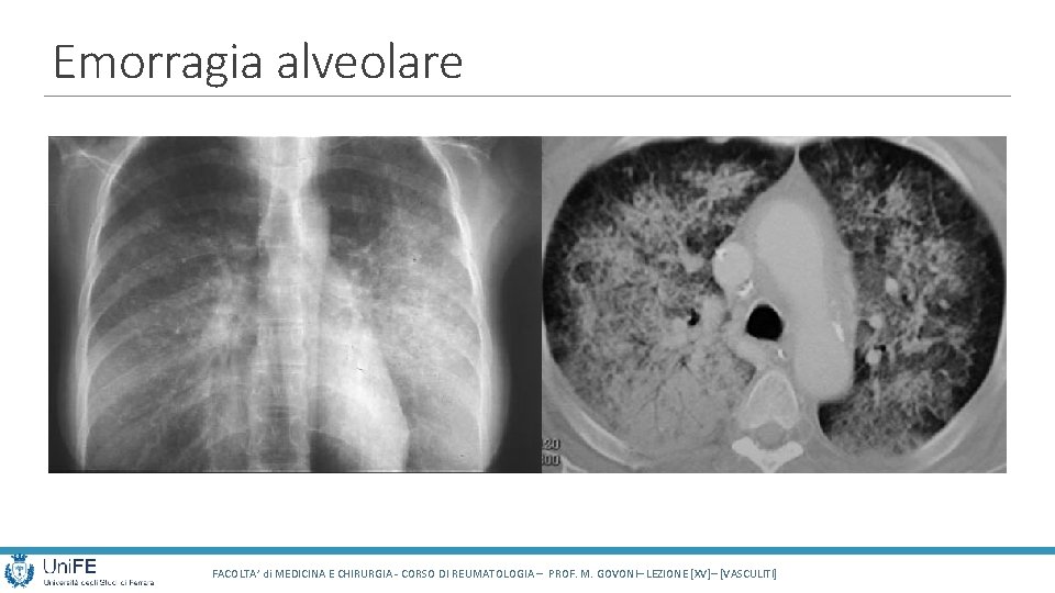 Emorragia alveolare FACOLTA’ di MEDICINA E CHIRURGIA - CORSO DI REUMATOLOGIA – PROF. M. Emorragia alveolare FACOLTA’ di MEDICINA E CHIRURGIA - CORSO DI REUMATOLOGIA – PROF. M.