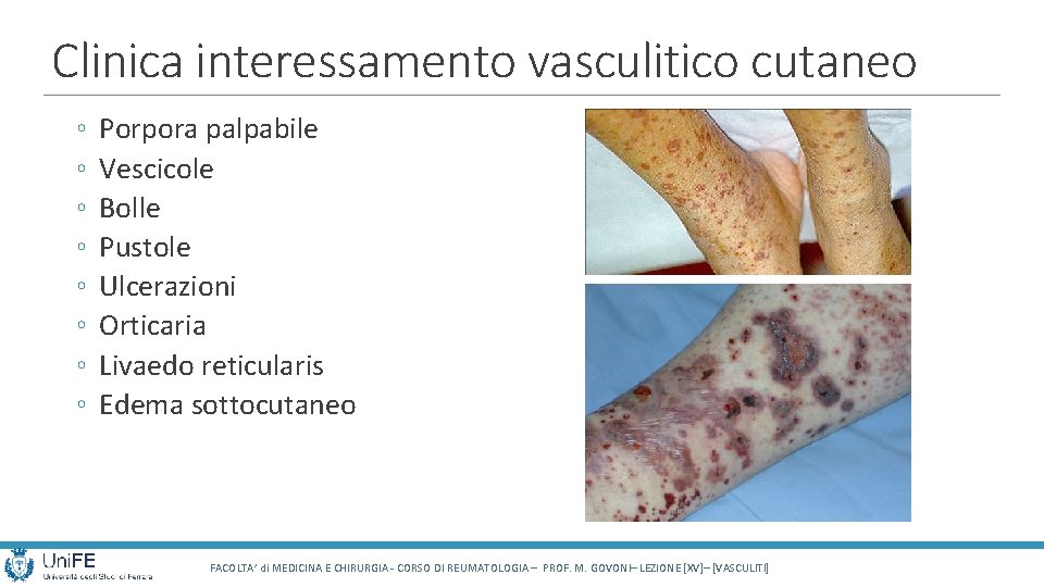 Clinica interessamento vasculitico cutaneo ◦ ◦ ◦ ◦ Porpora palpabile Vescicole Bolle Pustole Ulcerazioni Clinica interessamento vasculitico cutaneo ◦ ◦ ◦ ◦ Porpora palpabile Vescicole Bolle Pustole Ulcerazioni