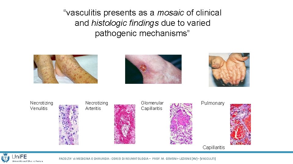 “vasculitis presents as a mosaic of clinical and histologic findings due to varied pathogenic “vasculitis presents as a mosaic of clinical and histologic findings due to varied pathogenic