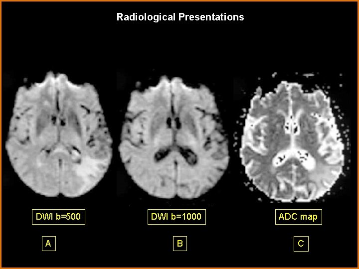 Radiological Presentations DWI b=500 A DWI b=1000 B ADC map C 