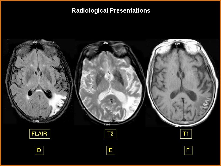 Radiological Presentations FLAIR T 2 T 1 D E F 