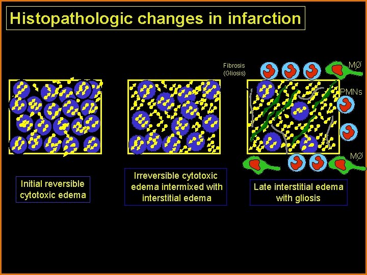 Histopathologic changes in infarction MO Fibrosis (Gliosis) PMNs MO Initial reversible cytotoxic edema Irreversible