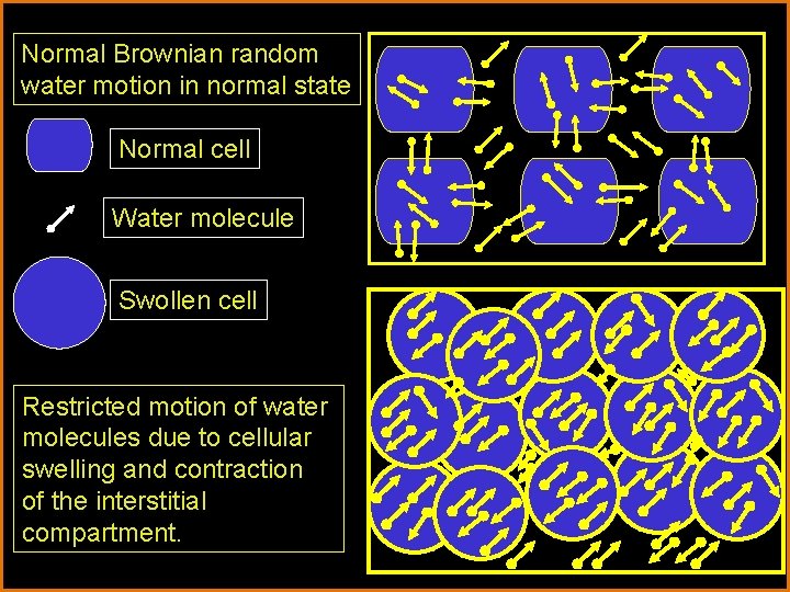 Normal Brownian random water motion in normal state Normal cell Water molecule Swollen cell Normal Brownian random water motion in normal state Normal cell Water molecule Swollen cell