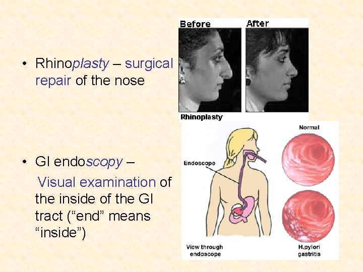  • Rhinoplasty – surgical repair of the nose • GI endoscopy – Visual