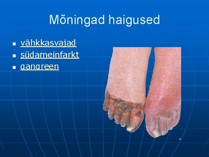 Mõningad haigused n n n vähkkasvajad südameinfarkt gangreen 