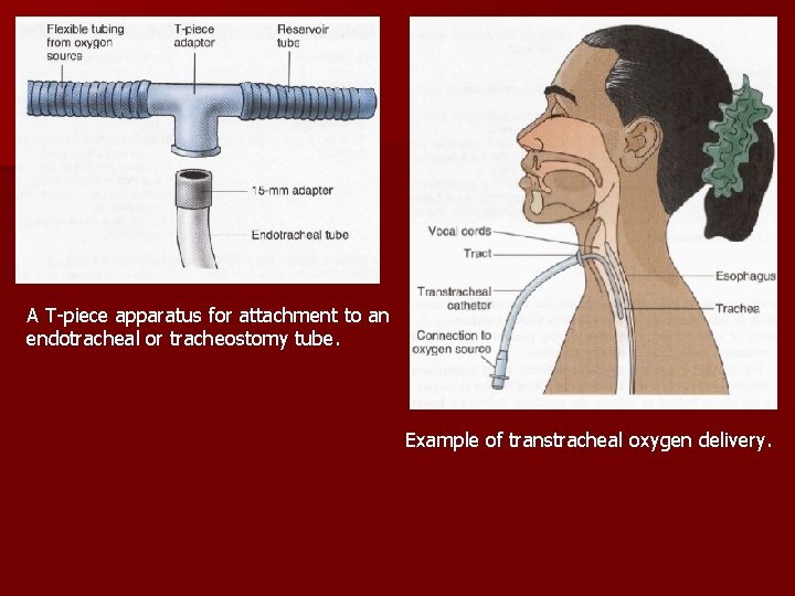 A T-piece apparatus for attachment to an endotracheal or tracheostomy tube. Example of transtracheal