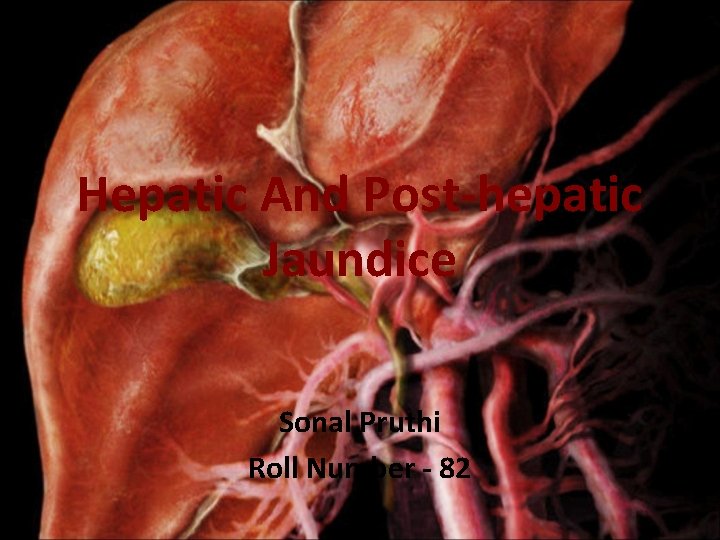 Hepatic And Post-hepatic Jaundice Sonal Pruthi Roll Number - 82 