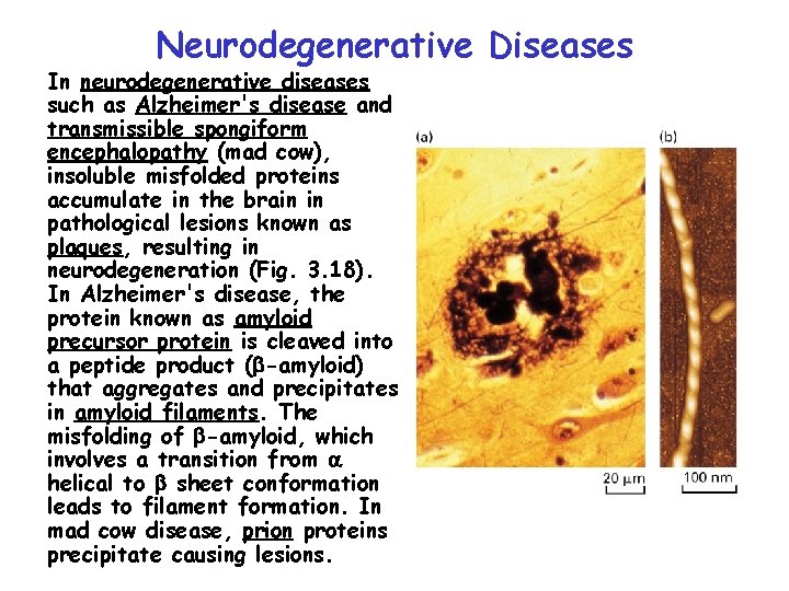 Neurodegenerative Diseases In neurodegenerative diseases such as Alzheimer's disease and transmissible spongiform encephalopathy (mad