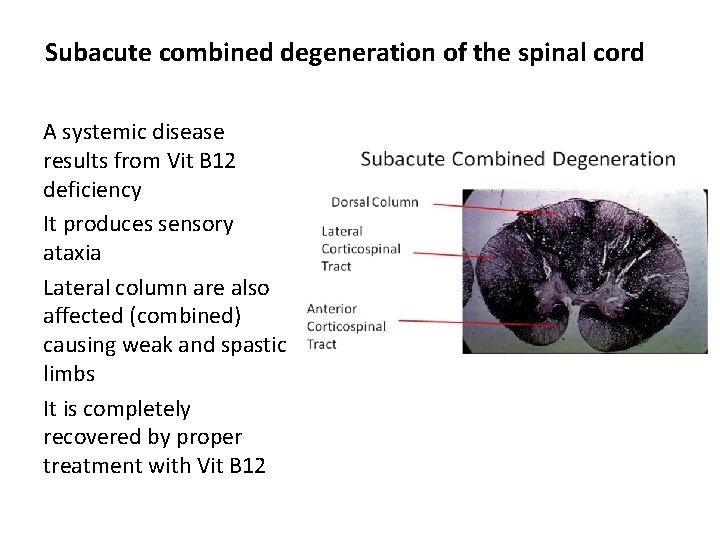 Subacute combined degeneration of the spinal cord A systemic disease results from Vit B