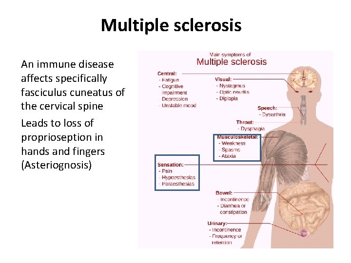 Multiple sclerosis An immune disease affects specifically fasciculus cuneatus of the cervical spine Leads