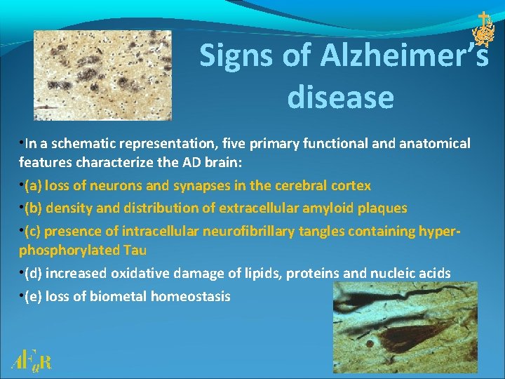 Signs of Alzheimer’s disease • In a schematic representation, five primary functional and anatomical