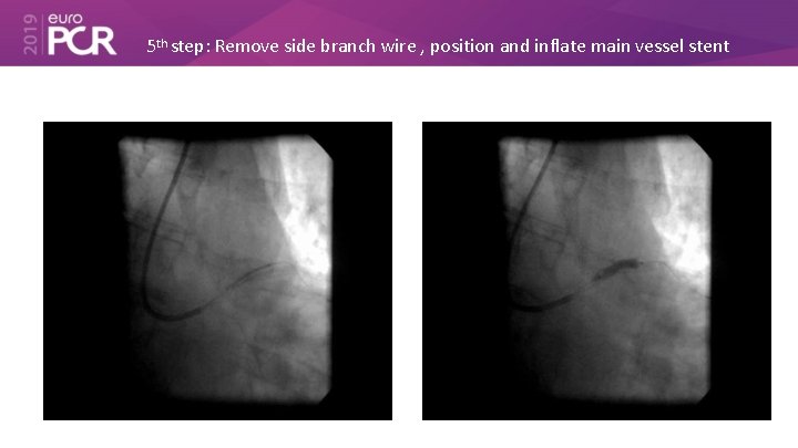 5 th step: Remove side branch wire , position and inflate main vessel stent