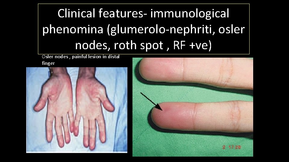 Clinical features- immunological phenomina (glumerolo-nephriti, osler nodes, roth spot , RF +ve) Osler nodes