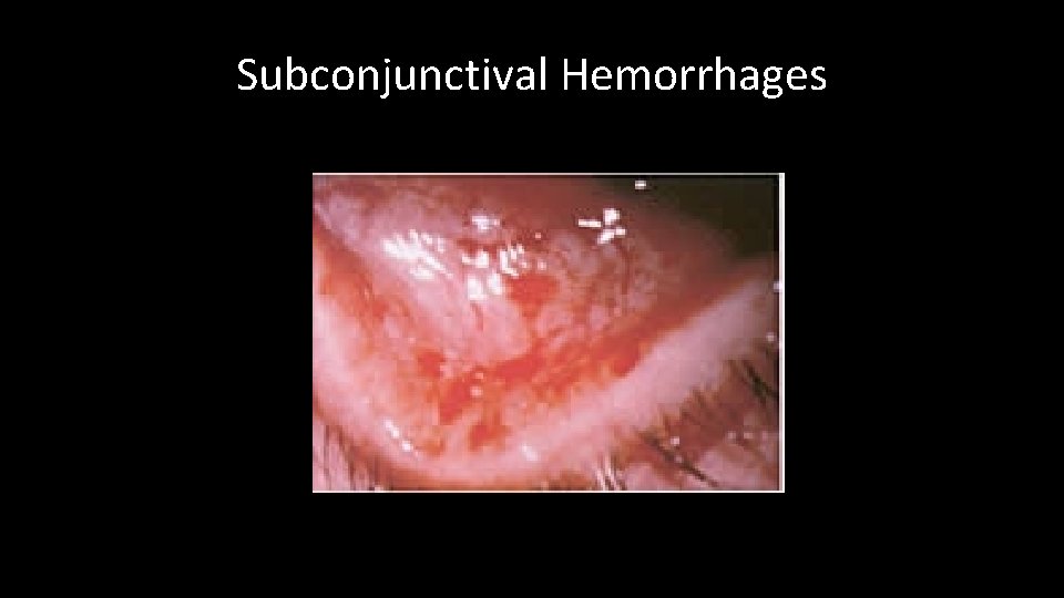 Subconjunctival Hemorrhages 