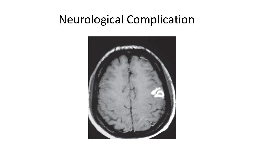 Neurological Complication Neurological Complication