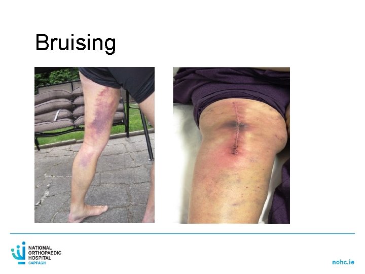 Bruising 