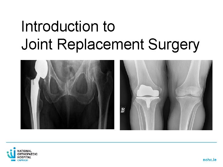 Introduction to Joint Replacement Surgery 