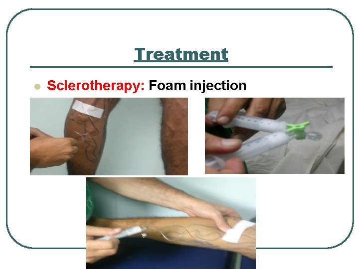 Treatment l Sclerotherapy: Foam injection 