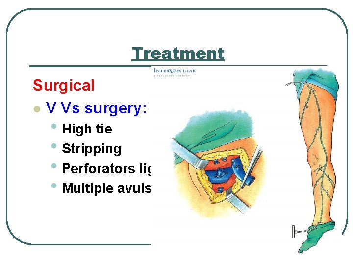 Treatment Surgical l V Vs surgery: • High tie • Stripping • Perforators ligation