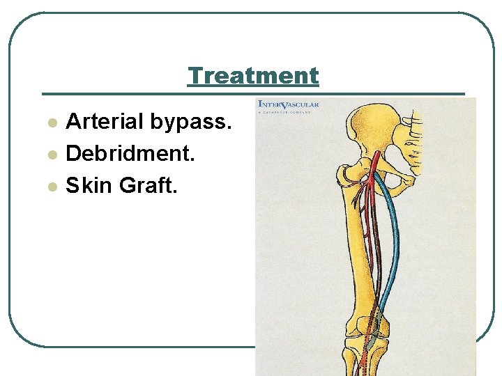 Treatment l l l Arterial bypass. Debridment. Skin Graft. 